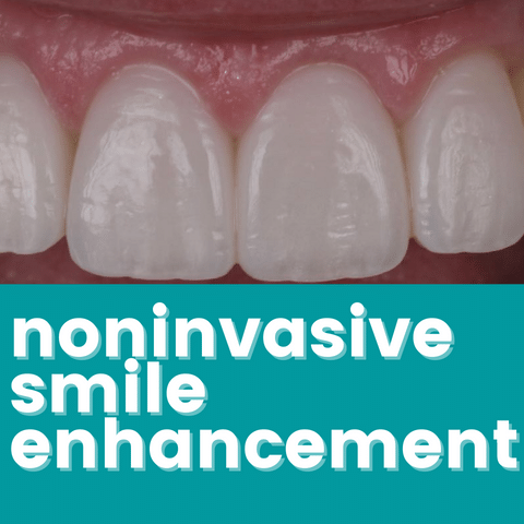 Non-Invasive Smile Enhancement with Direct Composite Veneers