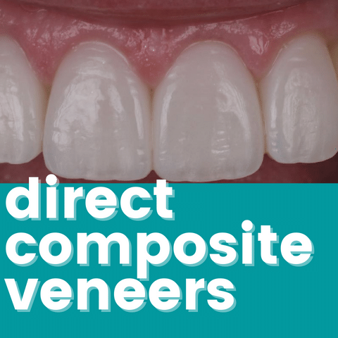 Direct Composite Veneers