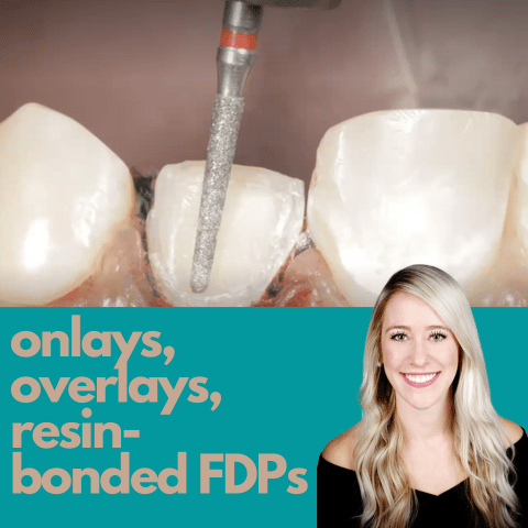 Onlays, Overlays, and Resin-bonded FDPs